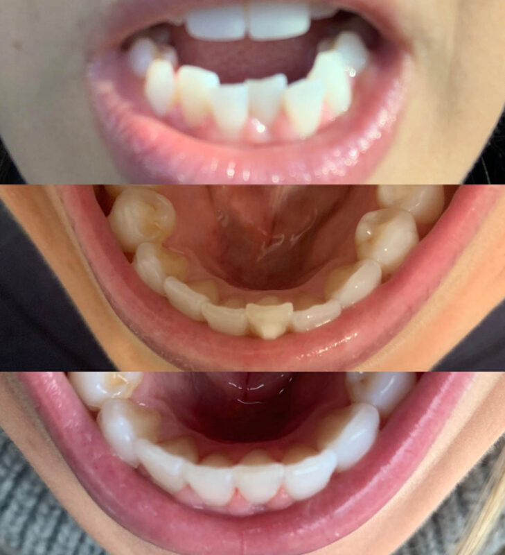 six month smiles before and after results